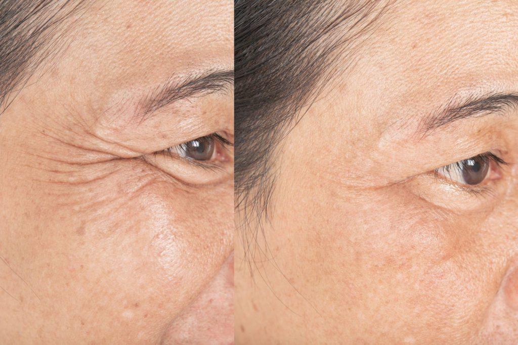 best microneedling pen before after